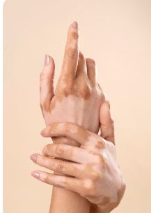 Vitiligo Treatment